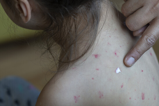 Ecdc, in Europa i contagi di morbillo decuplicati in un anno